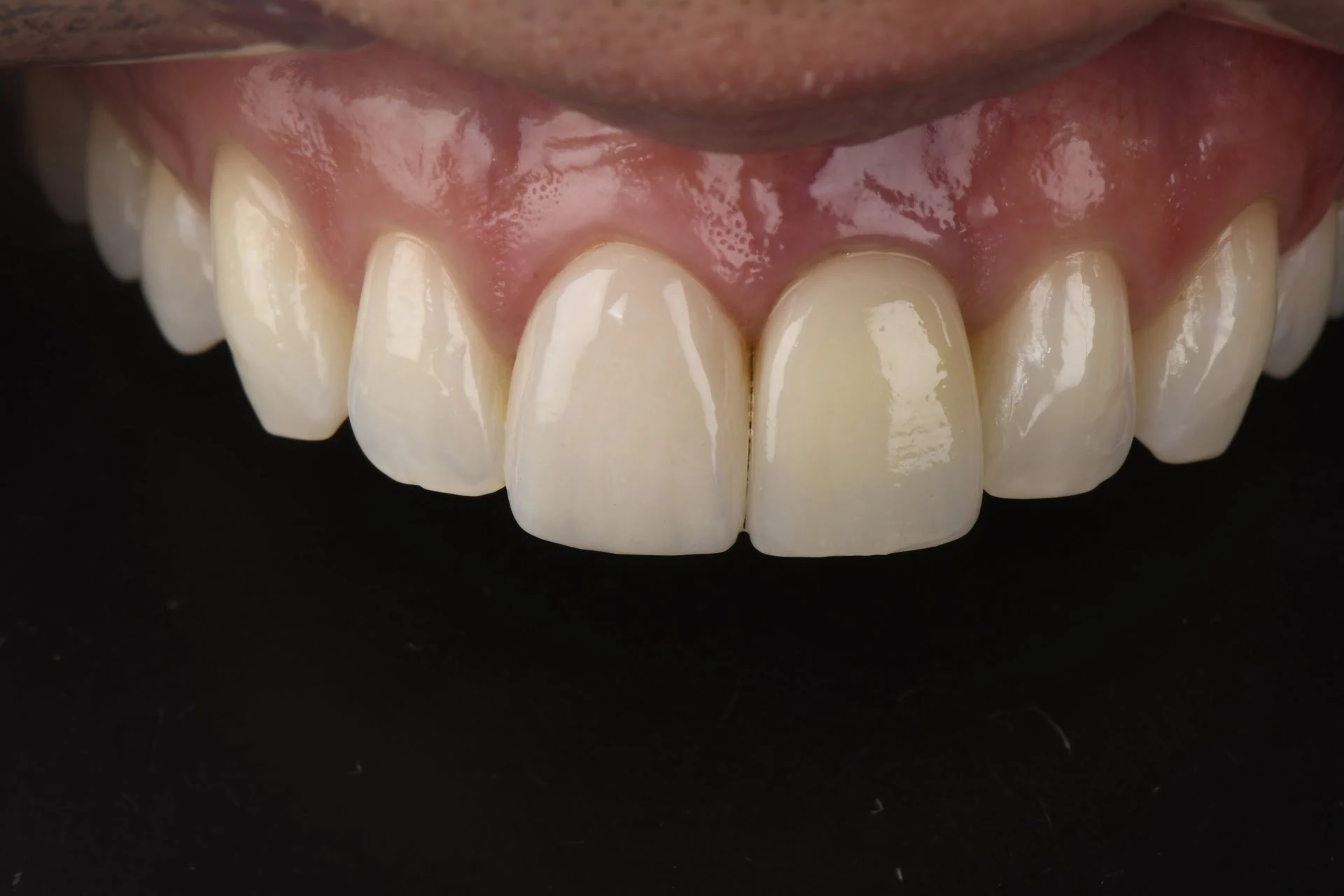Resultado dental restaurativo