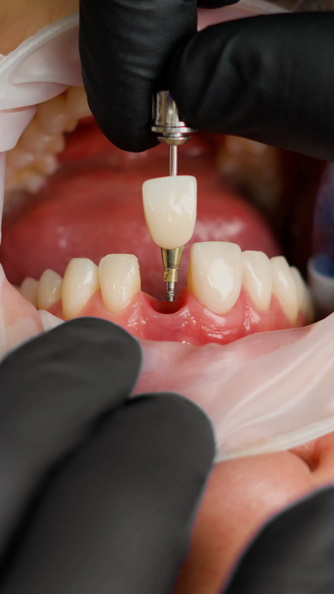 Procedimiento de implante dental